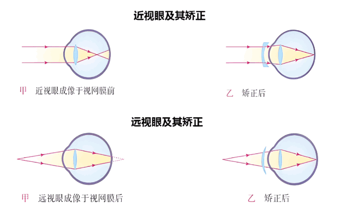 远视眼矫正